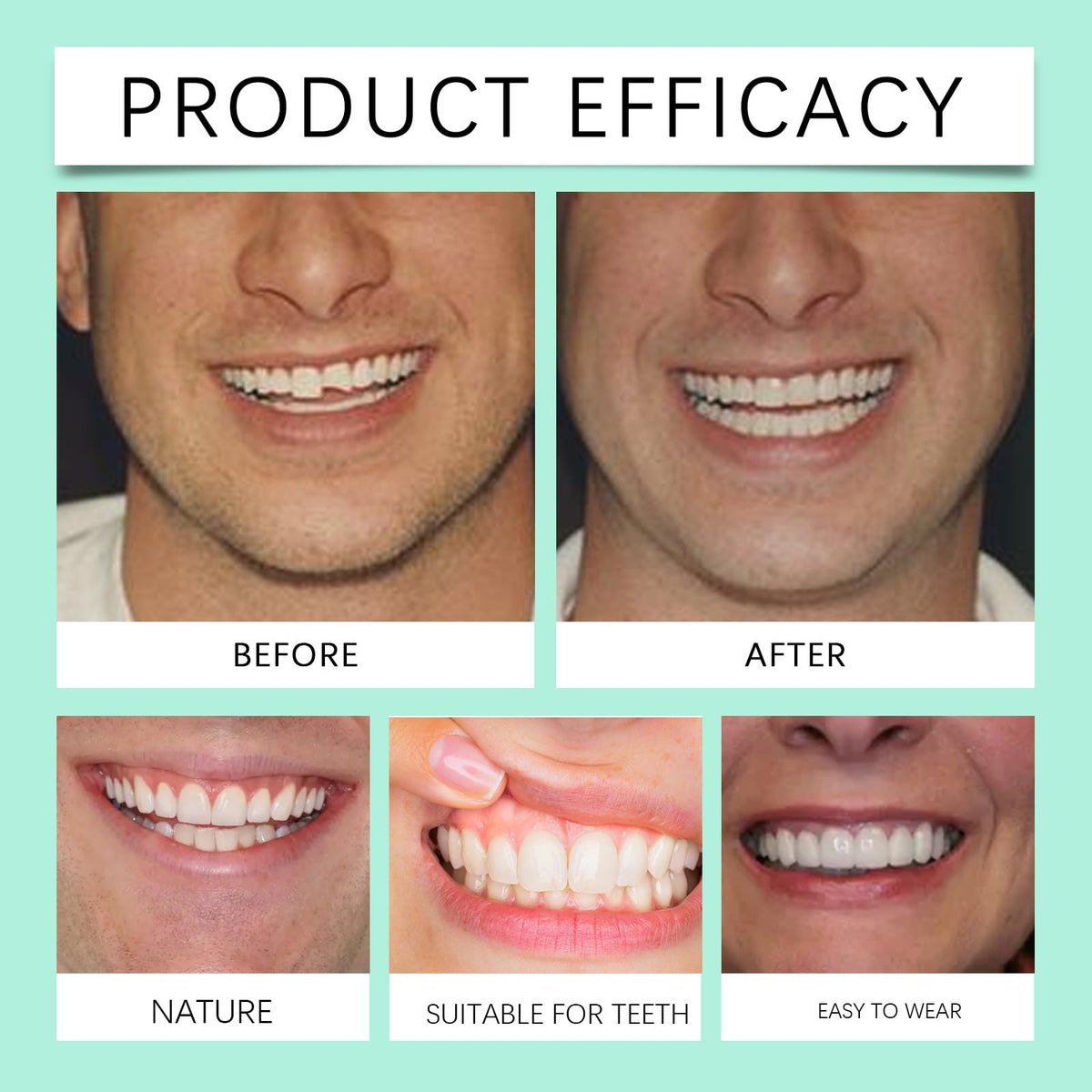 Silicone Veneers Upper & Lower Set O4964